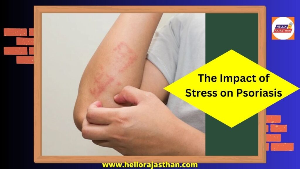 stress on Psoriasis, Biotechnology, psoriasis, immunity, Stress, Symptoms, Diagnosis, Homeopathic treatment, DR BATRA'S,