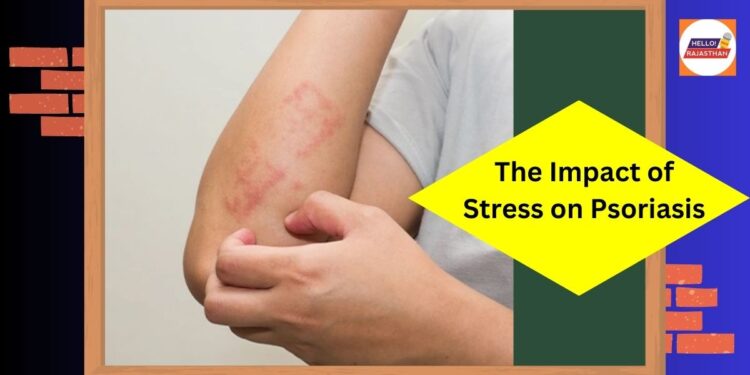 stress on Psoriasis, Biotechnology, psoriasis, immunity, Stress, Symptoms, Diagnosis, Homeopathic treatment, DR BATRA'S,