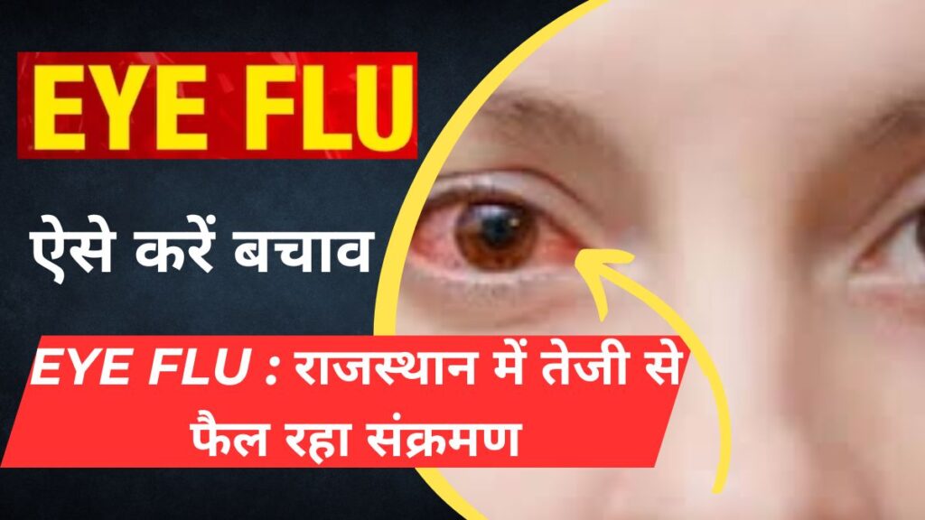 Eye Flu Havoc, eye flu, , More Details of eye flu, eye flu se kaise bachao krein, How to save of eye flu, eye flu treatment, Home made treatment for eye flu, Best ENT doctor in Rajasthan, ENT treatment, Bikaner PBM hospital, PBM News,
