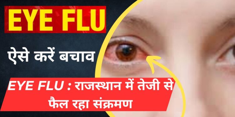 Eye Flu Havoc, eye flu, , More Details of eye flu, eye flu se kaise bachao krein, How to save of eye flu, eye flu treatment, Home made treatment for eye flu, Best ENT doctor in Rajasthan, ENT treatment, Bikaner PBM hospital, PBM News,